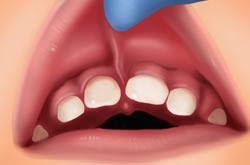 atlanta frenectomy center tongue