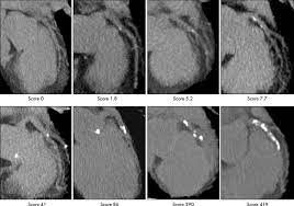 coronary artery calcification imaged
