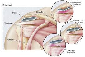 shoulder pain treatment
