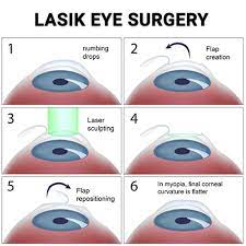 lasik eye surgery in nyc vitreous