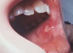 mouth sores spots navarro dental group