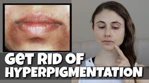 hyperpigmentation around the mouth