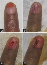 a d a larger nail bed glomus tumour is