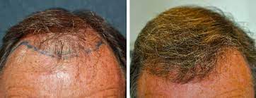 hair transplant falling out after 1