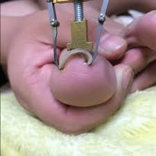 ingrown toenails pedicure tool