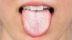 the white tongue bad breath conundrum