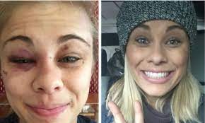 If you've seen her face in some of her fights she was a bloody mess. Paige Vanzant Looks Completely Recovered Despite Ufc Star Suffering Black Eye And Cut In Submission Loss To Rose Namajunas Daily Mail Online