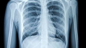 Presence of metallic objects within the area of examination. Chest X Ray For The Diagnosis Of Lung Cancer