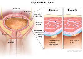 Here are the signs and symptoms of bladder and kidney cancer. Bladder Cancer Treatment Bladder Cancer Pictures Signs Symptoms To Better Understand Diagnosis Cleveland Oh University Hospitals