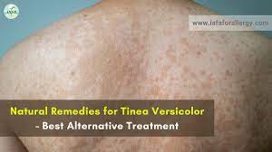 natural remes for tinea versicolor