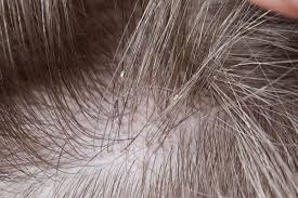 24 yrs old female asked about lice in my baby hair, 1 doctor answered this and 32 people found it useful. Close Up Of Head Lice Egg Lice Eggs Louse Flowers In Hair