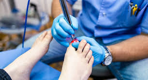 laser treatment for toenail fungus to