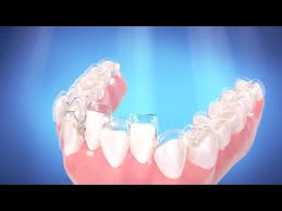 Moving the teeth physically includes various orthodontic options and adding something to the front of the tooth can be done. Invisalign Dentist Greenwood Straight Teeth Without Braces Youtube