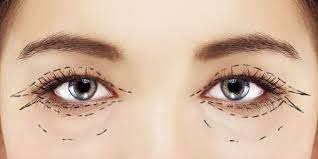 blepharoplasty seattle eyelid surgery