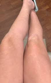 white spots on legs during pregnancy
