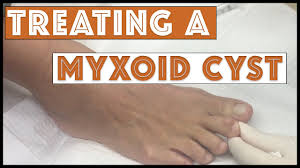 draining treating a myxoid cyst you