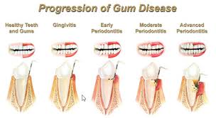 Image result for progression of gum disease
