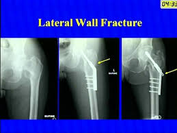 peritrochanteric fractures dhs vs im