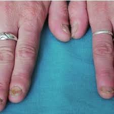thumb nails due to nail biting