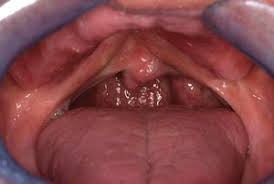 submucous cleft palate british dental