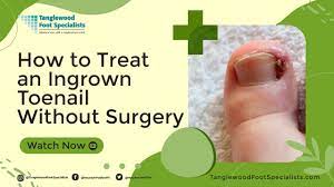 an ingrown toenail without surgery