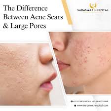 acne scars and large pores