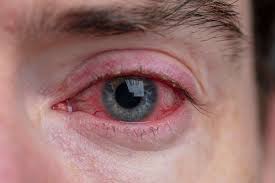 blepharitis eye patient