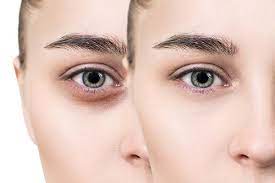 remove dark circles under the eyes