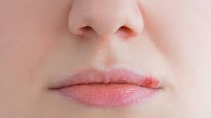 hide a cold sore with makeup