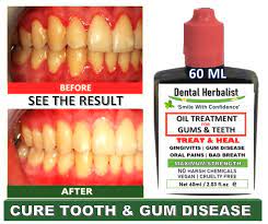 tooth gum disease periodonis