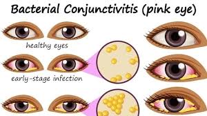 conjunctivitis simple home remes to