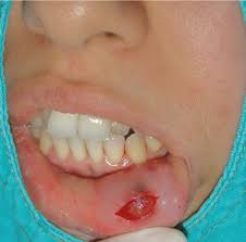 type of cavity tumors springerlink