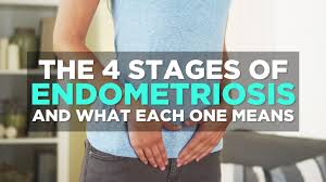 Check spelling or type a new query. The 4 Stages Of Endometriosis And What Each One Means Health Com