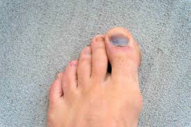 toenail fungus removal specialists in