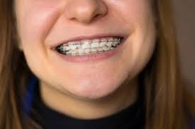Treating a toothache with salt water can also help heal any oral wounds and reduce inflammation. Do Braces Move Your Teeth Everyday Page 1 Of 0 Southern Orthodontic Specialists