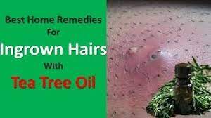 remes for reducing ingrown hairs