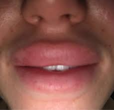 lips super swollen after restylane i