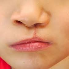 cleft palate cleft lip ear nose and