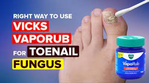 treat toenail fungus with vicks vaporub