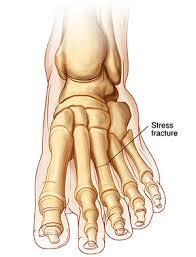 stress fractures motus physical therapy