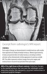 should i have meniscus surgery reviews