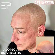 alopecia micropigmentation get your