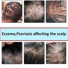 Lightening of treated areas of dark skin. 30ml Dermovate Scalp Application 0 05 Clobetasol Eczema Psoriasis Affecting The Scalp Scalp Cream Patches Aliexpress