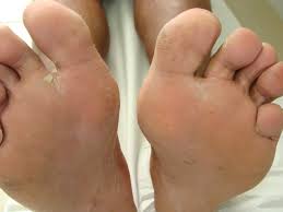 As infecções fúngicas ocorrem nas unhas dos pés mais frequentemente do que nas unhas das mãos. Fungos De Unha E Micose De Pele Dr Cesar Bimbi