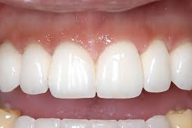 dental bridge before and after