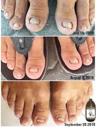 how to get rid of foot fungus fast