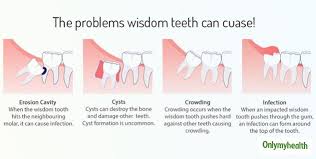 no more bearing wisdom tooth pain try