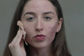 skin conditions such as eczema and acne