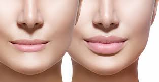 what does lip augmentation mean