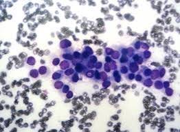 Fine needle aspiration cytology and histology did not correlate in 32 (20 per cent) patients and fnac was inadequate in nine (5.6 per cent) cases. Image Result For Papillary Carcinoma Thyroid Fine Needle Aspiration Cytology Floral Rings Floral Thyroid